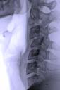Radiography photo of a Spinal Cord Injury